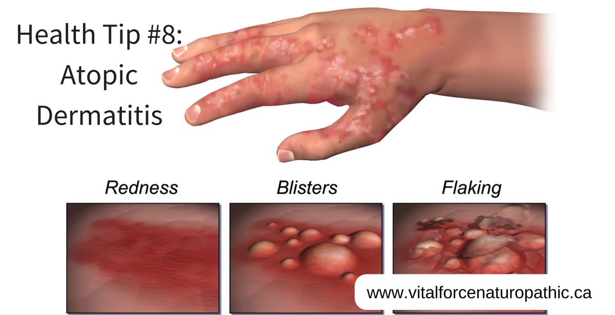 Vital Force Health Tip #8: Atopic Dermatitis